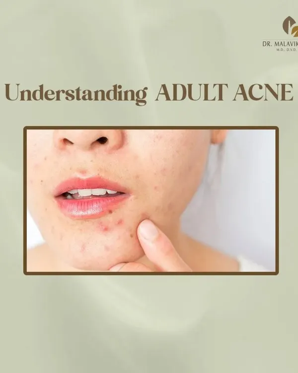 Understanding the underlying cause of adult acne is the first step toward effective management. This condition is often multifactorial, involving hormonal fluctuations, stress, and other triggers that require a targeted dermatological plan.