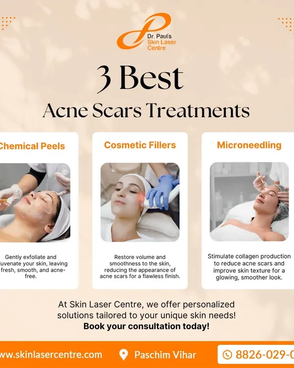 This graphic outlines my core treatment strategies for acne scars. I use chemical peels for exfoliation, cosmetic fillers to lift depressed scars, and microneedling to stimulate your skin's natural healing and collagen production for long-term improvement.