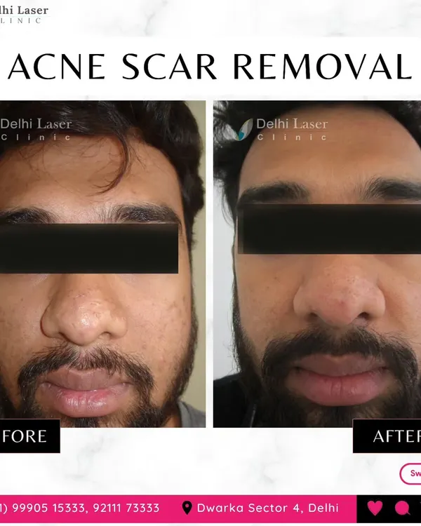 This before-and-after demonstrates the results of my customized acne scar removal plan. By combining different laser modalities, I can address various scar types on the face for a smoother, more uniform skin surface.