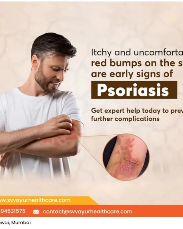Psoriasis manifests as itchy, red, and scaly patches on the skin. My treatment plan for psoriasis involves internal detoxification, herbal medications, and lifestyle guidance to manage the condition effectively and reduce the frequency of flare-ups.