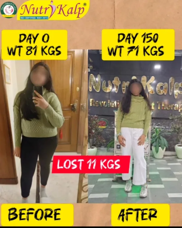 From 81 kgs to 71 kgs in 150 days. This 11 kg weight loss journey shows the power of consistency and a balanced diet plan that fits into your daily life.