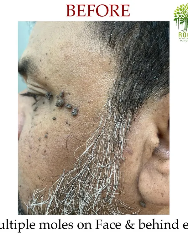 This "before" image shows a client with multiple moles on his face and behind his ears prior to starting Agnikarma therapy.