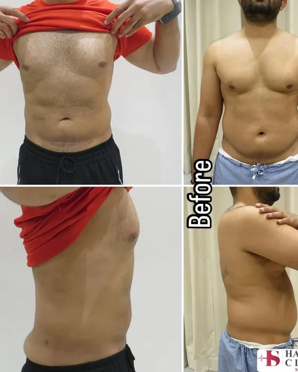 This before and after image demonstrates the transformative power of liposuction on the male torso. The procedure effectively removed stubborn fat from the abdomen and flanks, sculpting a more defined and athletic contour. This result is permanent, provided a stable weight is maintained.