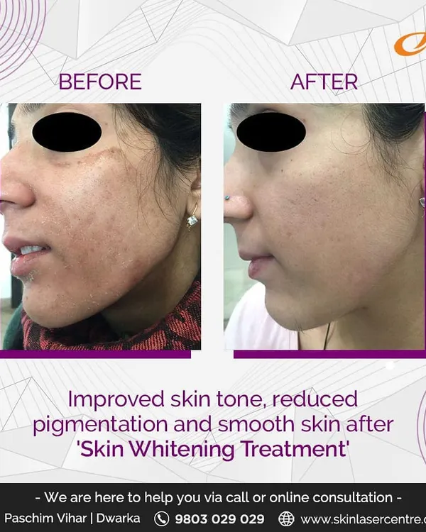 This patient achieved a more even skin tone and reduced pigmentation after a skin whitening treatment. This procedure, often a chemical peel, helps regenerate the skin for a smoother appearance.