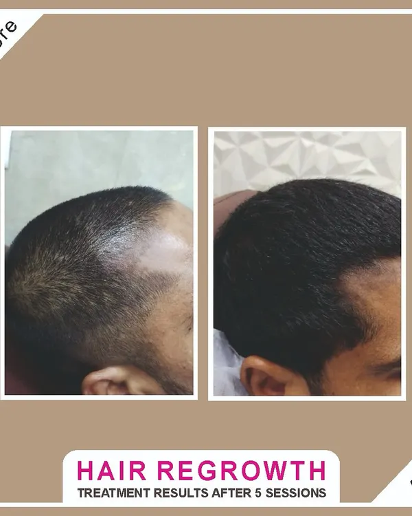 This is the kind of transformation that makes my work so rewarding. This client was dealing with male pattern baldness and after a personalized plan of 5 hair regrowth sessions, we achieved this significant increase in hair density and coverage.