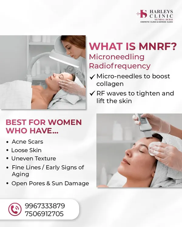 Microneedling Radiofrequency, or MNRF, is a powerful combination therapy. Micro-needles create tiny channels in the skin to boost collagen, while radiofrequency waves deliver heat to tighten and lift. It's highly effective for acne scars, loose skin, and uneven texture.