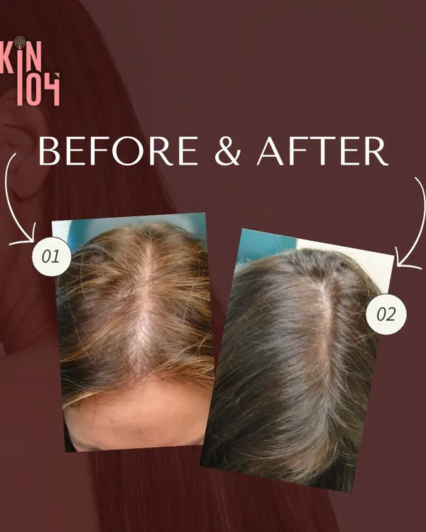This is the result of our personalized hair restoration plan. This before and after showcases a significant improvement in hair density and scalp coverage after a course of PRP treatments, effectively reversing visible thinning.