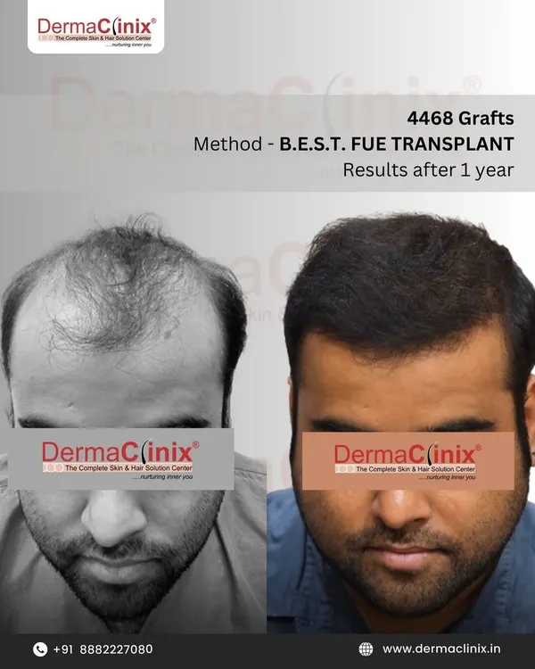 A one year transformation using our B.E.S.T. FUE method with 4468 grafts. We focus on creating a perfectly natural looking hairline that blends seamlessly, showcasing the blend of our artistic and surgical skills.
