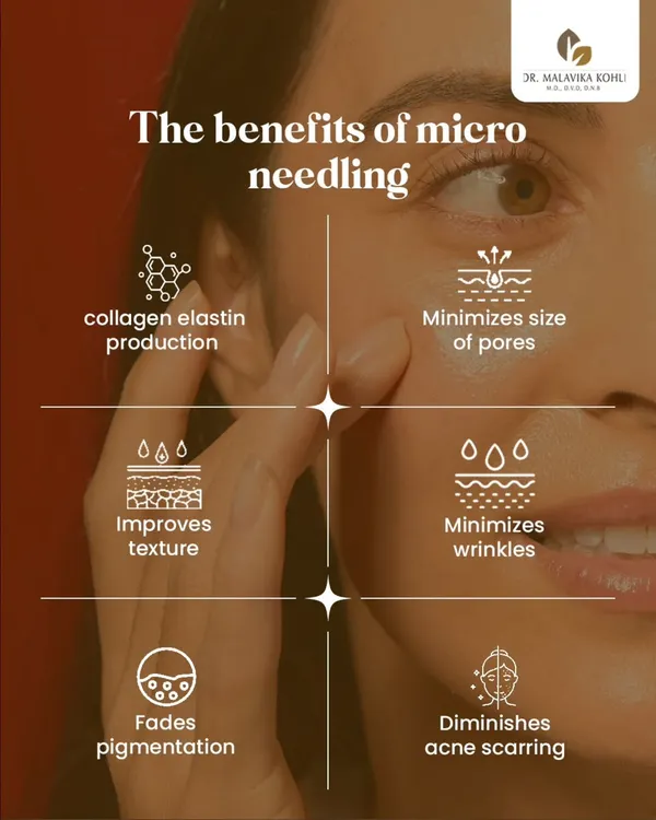 Microneedling is a sophisticated procedure that stimulates your skin's natural reparative processes. It is highly effective for improving texture, minimizing pores, fading pigmentation, and diminishing acne scarring by boosting collagen and elastin production.