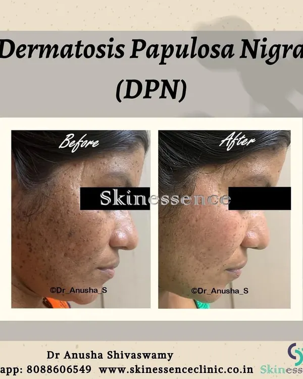 Here is a clear before and after example of Dermatosis Papulosa Nigra (DPN) treatment. These common, harmless growths on the face can be a significant cosmetic concern. Using precise removal techniques, I can achieve clear, smooth skin for my patients, as seen in this transformation.