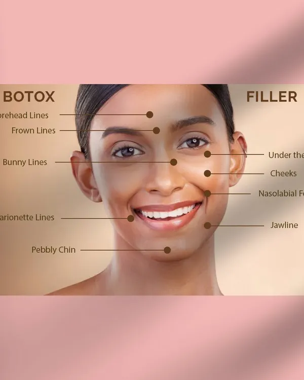 This facial map clearly distinguishes between the areas I treat with Botox versus Fillers. Botox addresses dynamic wrinkles caused by muscle movement, while fillers restore volume and treat static lines.