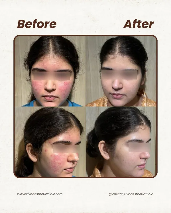 This is a powerful example of treating severe inflammatory acne. We focused on reducing the inflammation first, then clearing the active breakouts, and finally addressing the redness and texture. It's a step-by-step process that delivers lasting results.