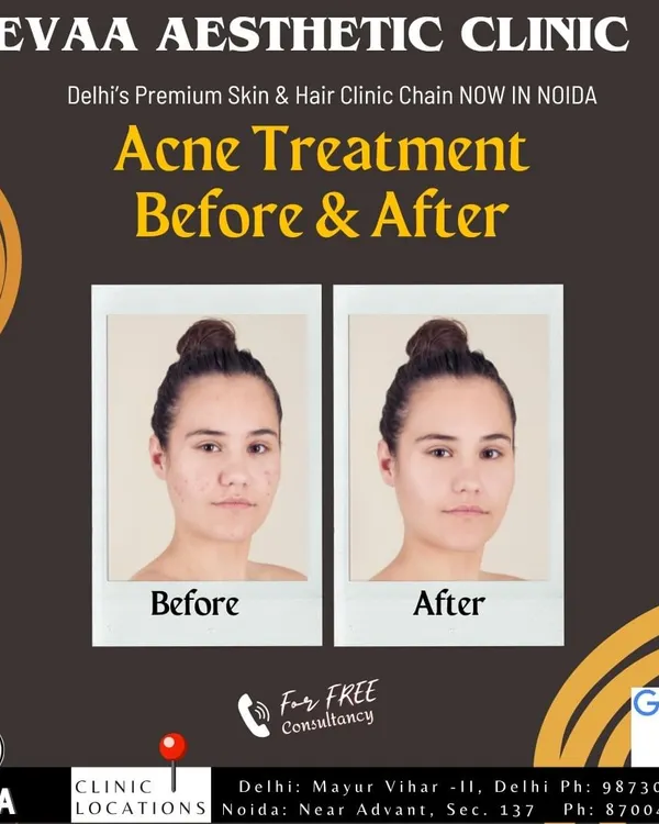 A before-and-after comparison demonstrating the effectiveness of our acne treatment protocols in clearing breakouts and improving skin clarity.