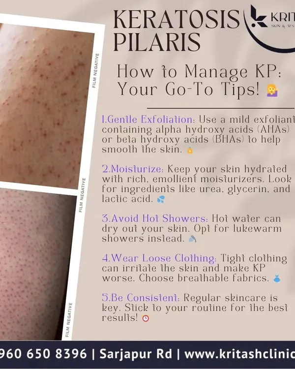 Keratosis Pilaris, or KP, presents as small, rough bumps on the skin. Management involves a consistent routine of gentle chemical exfoliation with ingredients like lactic or glycolic acid, followed by a rich moisturizer containing urea or glycerin to soften the keratin plugs.