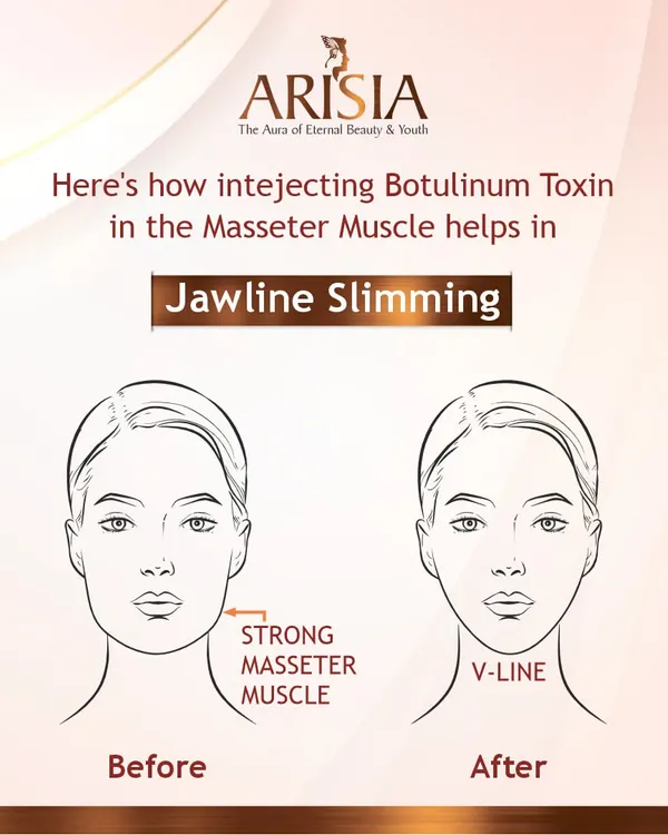 This illustration shows how injecting Botulinum Toxin into the masseter muscle achieves jawline slimming. By relaxing this strong muscle, we can transition the face from a square shape to a more defined V-line.