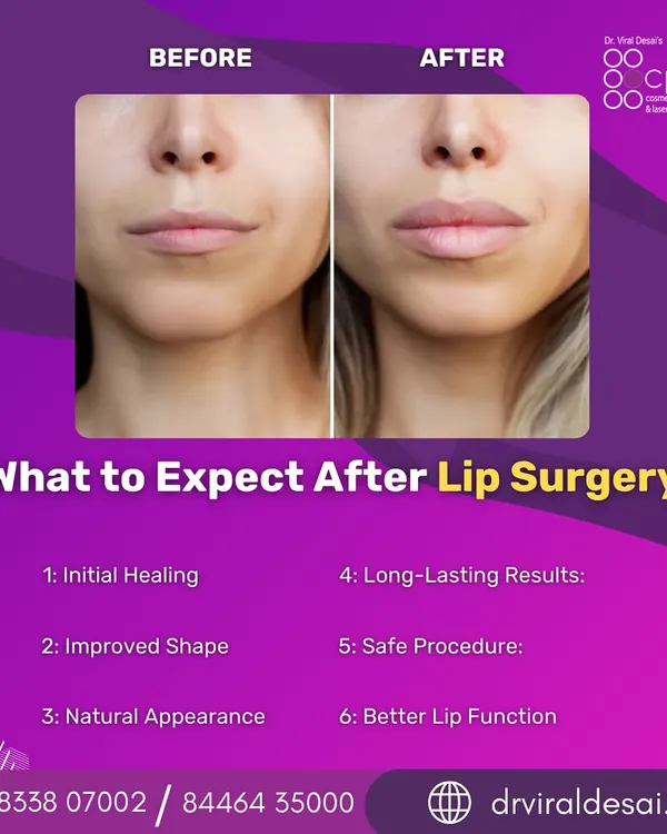 This before-and-after image demonstrates the subtle yet significant impact of lip surgery. My focus is on creating a natural-looking enhancement that restores volume and improves shape, ensuring the results are in perfect harmony with your overall facial features.