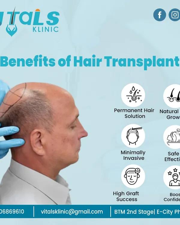 This graphic summarizes the key benefits of a hair transplant. It is a permanent solution that provides natural hair growth through a minimally invasive and safe procedure. The high success rate of graft survival directly translates to a significant boost in confidence for our patients.