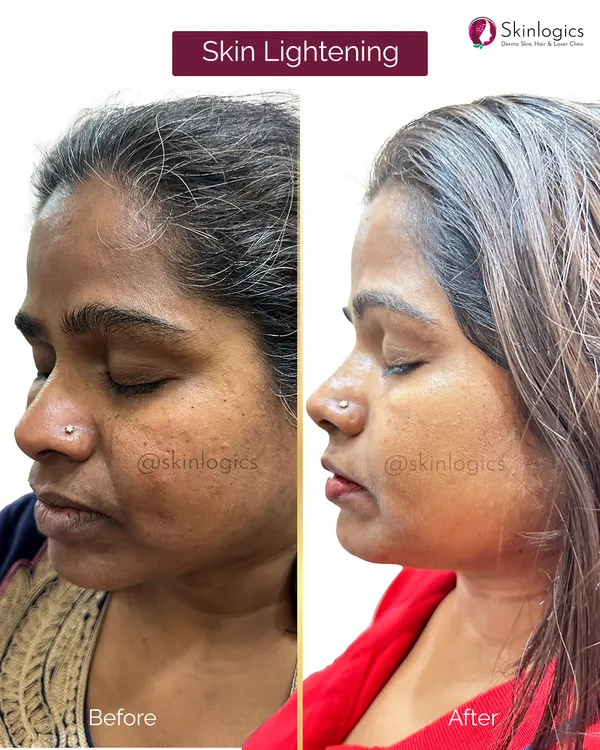 A clear example of our skin lightening treatment. The 'before' image shows dullness and uneven pigmentation, while the 'after' image displays a visibly brighter, more luminous, and even-toned skin, achieved through a personalized treatment protocol.