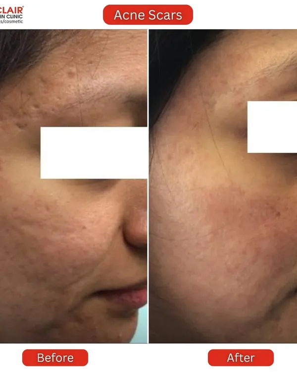 This is the kind of transformation that inspires us every day. This client came to us with deep, textured acne scars and uneven skin tone. Through a personalized treatment plan, we were able to significantly smooth the skin's surface, reduce the depth of the scars, and restore a healthier, more even complexion.