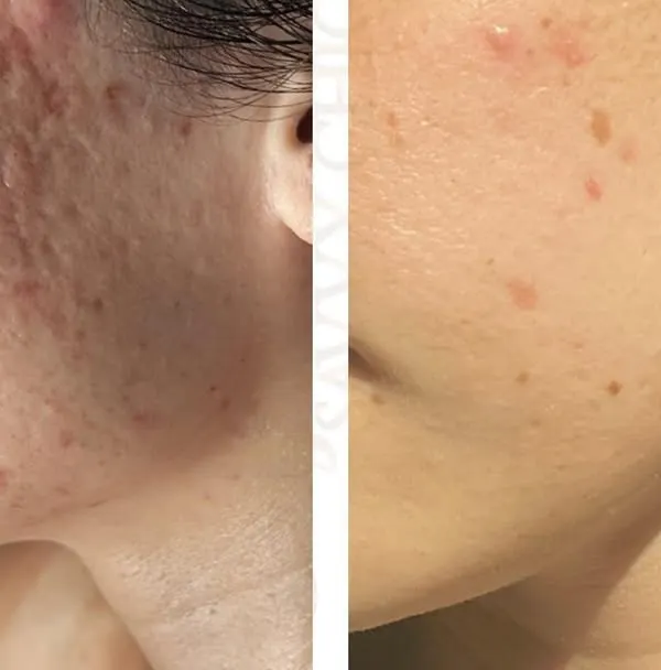 This before-and-after demonstrates a significant reduction in deep, textured acne scars. My treatment plan combined multiple modalities to rebuild collagen and smooth the skin's surface, restoring both texture and confidence.