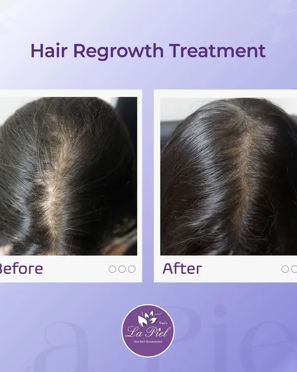 This before-and-after image shows a significant improvement in hair density for a patient concerned with a widening parting line. My focus is on creating personalized treatment plans that address the root cause of hair thinning to achieve visible, confidence-boosting results like this.