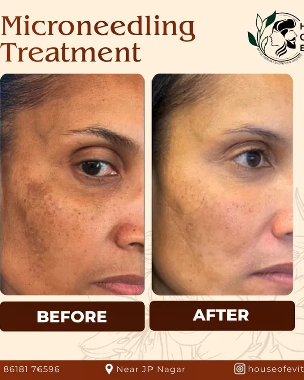 This before-and-after image shows the significant reduction in hyperpigmentation and sun spots after a series of microneedling sessions. We use this procedure to stimulate your skin's natural collagen production, effectively treating acne scars, fine lines, and uneven skin texture for a smoother, clearer complexion.