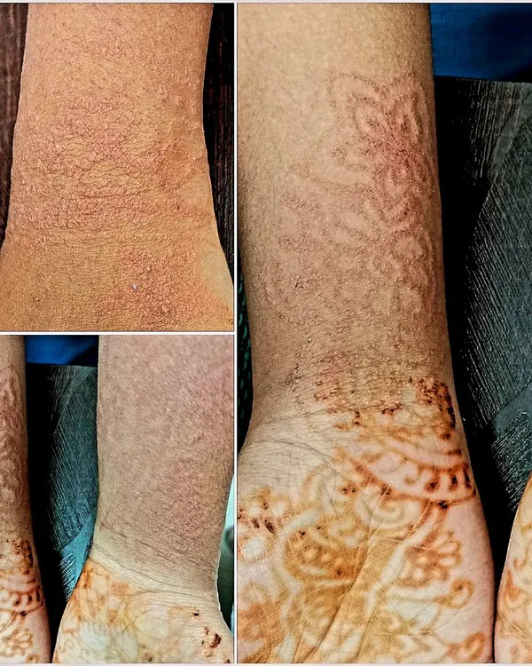 This is a case of irritant contact dermatitis caused by an allergic reaction to mehendi. It's a reminder to always do a patch test before applying products to your skin and to see a dermatologist immediately if you notice any irritation.