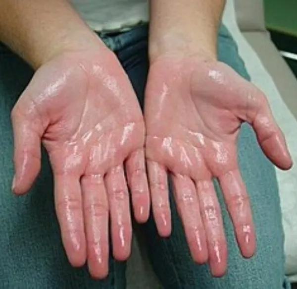Palmar hyperhidrosis, or excessive sweating of the hands, can be socially and professionally challenging. I offer effective treatments like Botox injections that can significantly reduce sweating and improve your quality of life.
