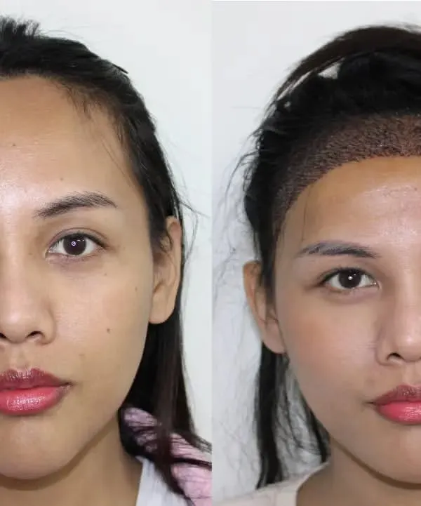 This patient wanted to lower her hairline to achieve better facial harmony. The 'before' shows her naturally high hairline, and the 'after' shows the immediate result post-procedure, with the new hairline clearly defined.
