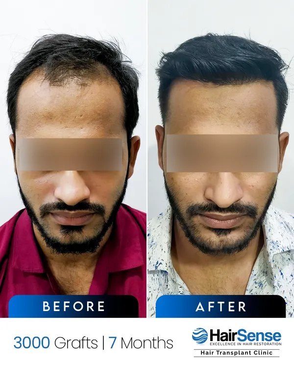 This is what a 7-month journey with 3000 grafts looks like. We focus on creating a dense, natural-looking hairline that completely transforms your appearance and restores your confidence. This is not just about adding hair; it is about precise, artistic restoration.