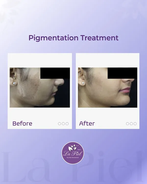 This before-and-after image shows a significant reduction in pigmentation after a personalized treatment plan. My goal is to address the underlying causes of uneven skin tone to restore clarity and achieve a naturally radiant complexion.