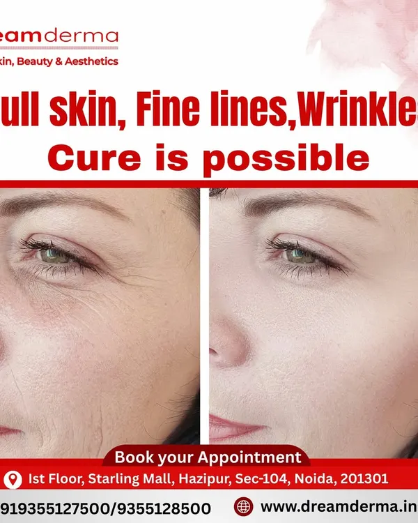 A clear before and after comparison showing the visible reduction of fine lines and wrinkles, demonstrating the transformative results I can achieve for your skin.