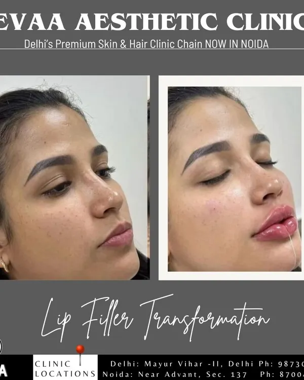 A stunning lip filler transformation. This before-and-after comparison shows how we can significantly enhance lip volume and shape, creating a fuller, more defined pout while maintaining a natural look.