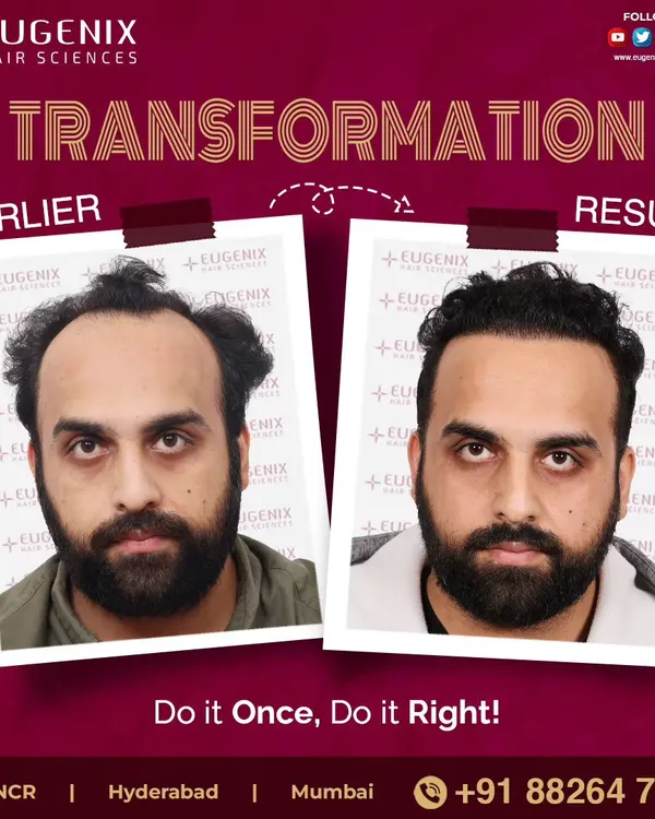 A clear comparison showing the powerful change a well-executed hair transplant can make. We focus on creating a result that is not only dense but also perfectly frames the face for a natural and revitalized appearance.