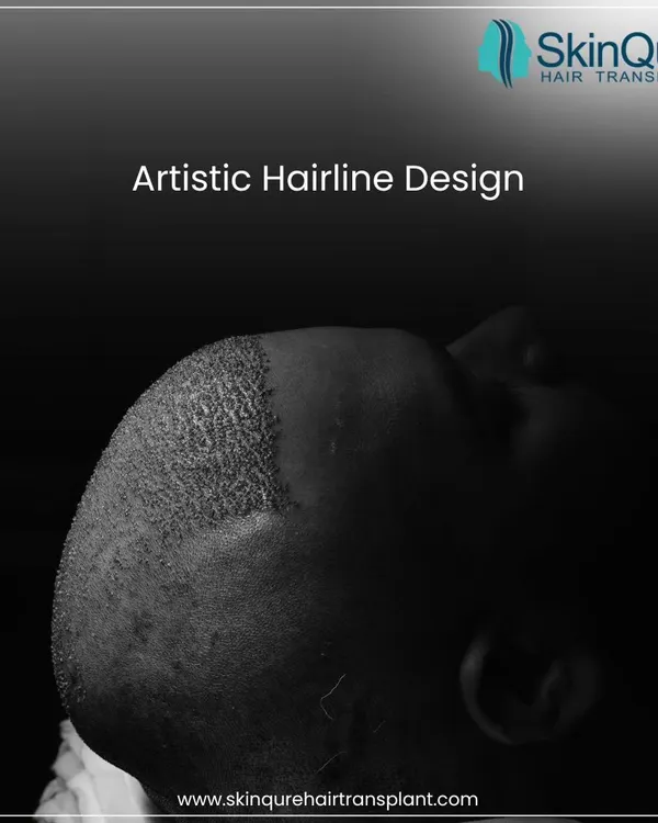 A hair transplant is not just a medical procedure; it is an art. Crafting a hairline that is both dense and natural requires an artistic eye. This image captures the essence of an artistic hairline design, which is the cornerstone of a result that you can be proud of.