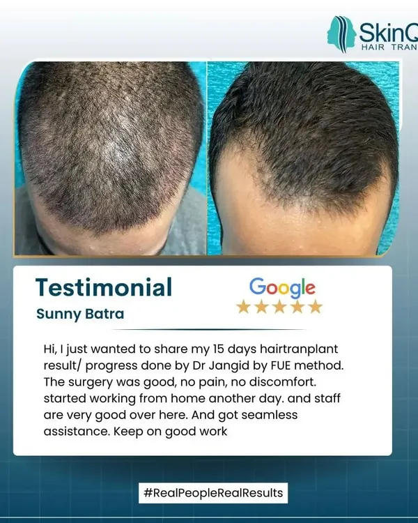 Sunny Batra shares his 15-day progress after an FUE procedure. He highlights that the surgery was good, with no pain or discomfort, and that he received seamless assistance from my team. It's great to see patients feeling comfortable and well-cared for.