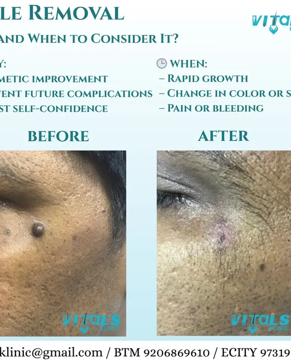 A clear before-and-after of a facial mole removal. The procedure was performed to enhance cosmetic appearance and boost the patient's confidence, leaving behind smooth, clear skin with minimal marking.