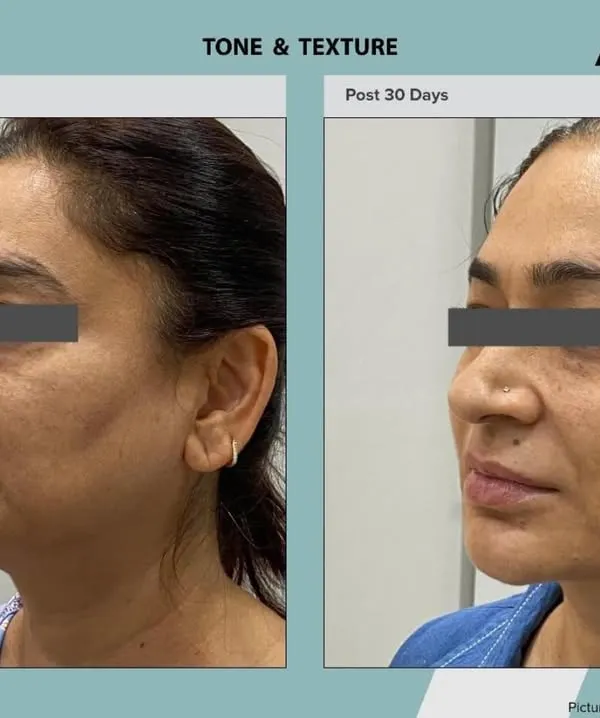 Before and 30 days after an AdvaTx laser treatment. This side profile view highlights the dramatic improvement in skin clarity, with a visible reduction in hyperpigmentation and a more even, luminous skin tone.