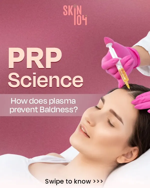 This image captures a moment from our PRP Science treatment, where plasma is precisely injected into the scalp. This procedure is designed to be comfortable while delivering powerful growth factors directly to the hair follicles to prevent baldness.