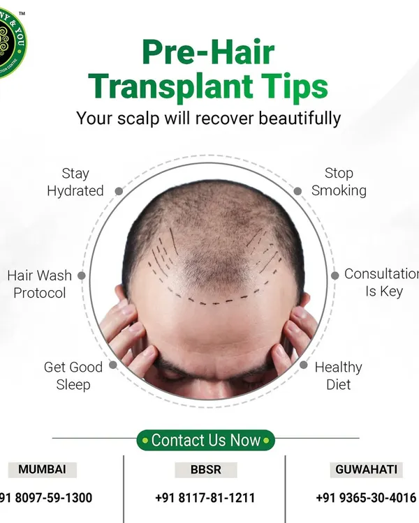 Preparing for your hair transplant is crucial for a successful outcome. This graphic outlines key pre-transplant tips, including staying hydrated, stopping smoking, and following a healthy diet, to ensure your scalp recovers beautifully.
