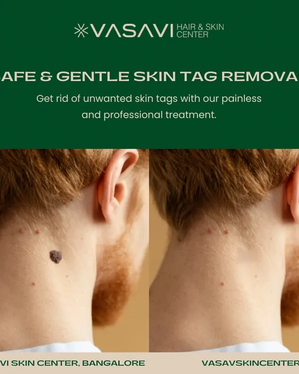 This is a typical result of a skin tag removal from the neck. The procedure is straightforward and provides an immediate cosmetic improvement, leaving the skin clear and smooth.