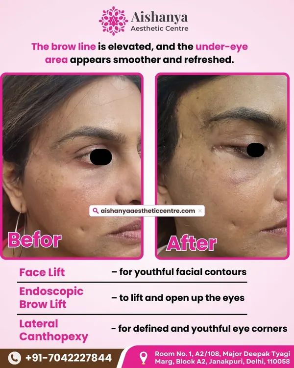 This is the result of combining a facelift for youthful contours, an endoscopic brow lift to open up the eyes, and lateral canthopexy for defined eye corners. My goal is always a significant yet natural-looking rejuvenation that restores confidence.