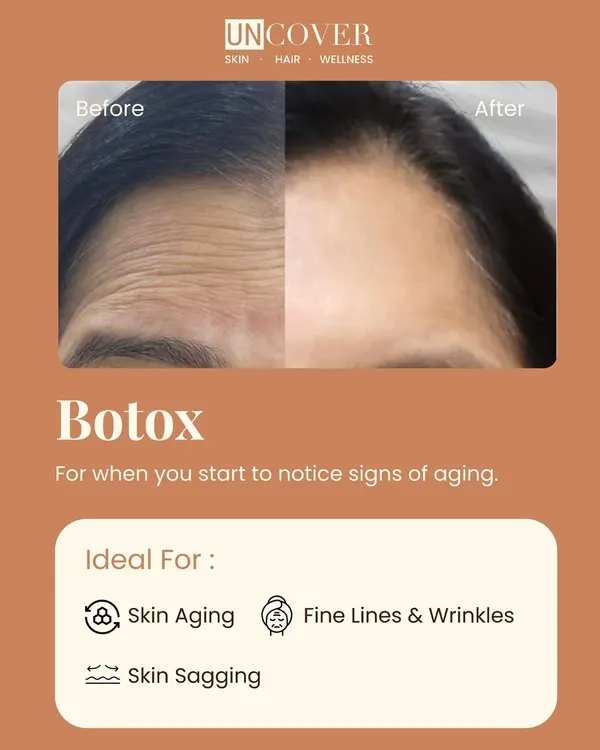 A clear before-and-after look at how we use Botox to smooth forehead lines. Our goal is always a natural, refreshed result that makes you look like the best version of yourself, never stiff or overdone.