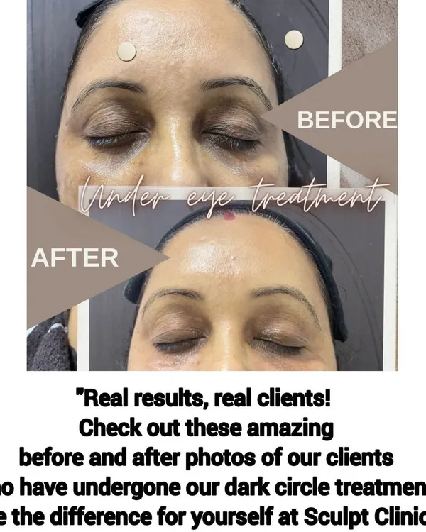 A real client's before-and-after results from our dark circle treatment. This image clearly shows the significant reduction in pigmentation and hollowness, resulting in brighter and more refreshed-looking eyes.