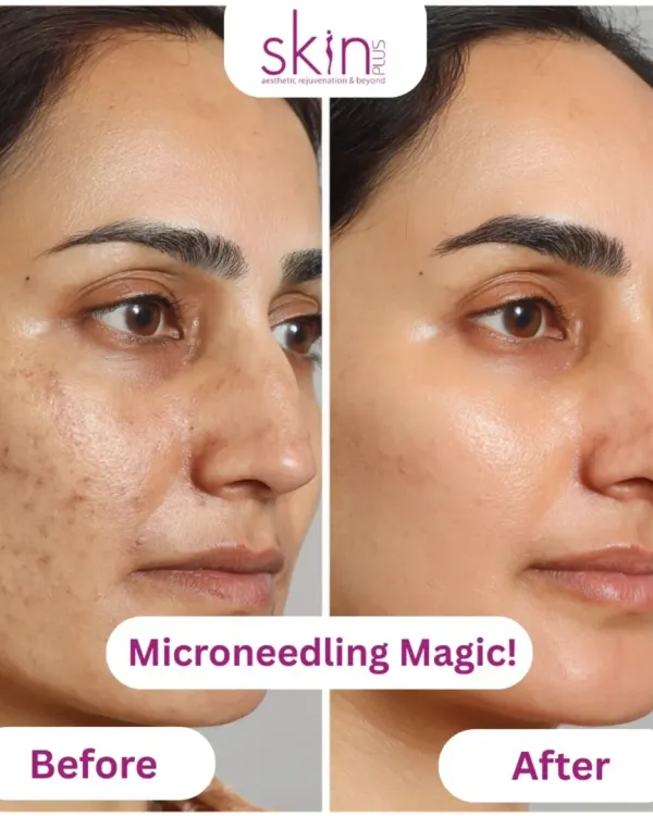 A powerful before-and-after comparison showcasing the transformative results of microneedling. This demonstrates my ability to significantly reduce acne scarring and improve overall skin texture for a smoother, clearer complexion.