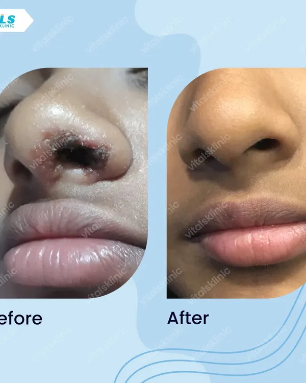 This before-and-after shows the successful removal of a pigmented lesion on the nose. Using precise techniques, we can safely remove unwanted spots and restore the skin's clear, even appearance.