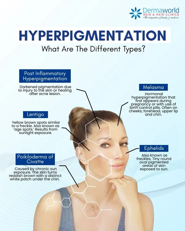Hyperpigmentation is not a single condition. This educational graphic explains the different types, from post-inflammatory marks after acne to melasma and sun-induced lentigo. Each type requires a specific treatment approach for effective results.