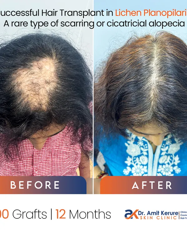 This before-and-after shows a successful 1800-graft hair transplant on a patient with Lichen Planopilaris. The key was to wait until the scalp inflammation was controlled, which allowed for excellent graft survival and coverage on the scarred scalp.
