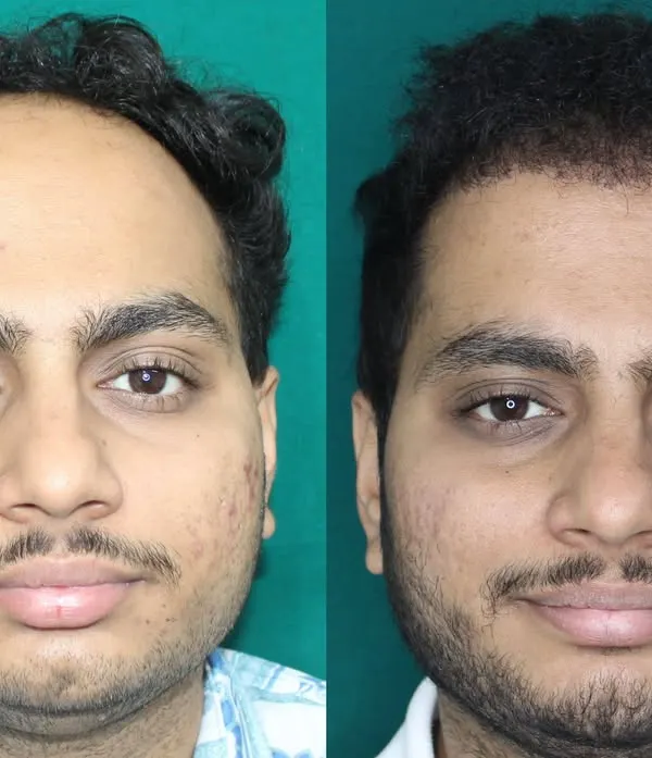 This front-on view shows the dramatic impact of a restored hairline. The patient's face is now framed naturally, giving him a much younger and refreshed look. This is the power of a well-designed hair transplant.