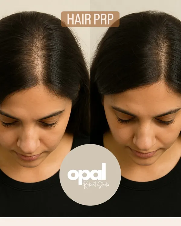 This is the result we work towards. This client saw a significant improvement in hair density and a fuller scalp after completing her PRP hair regrowth sessions with me. It's a powerful solution for female pattern hair thinning.
